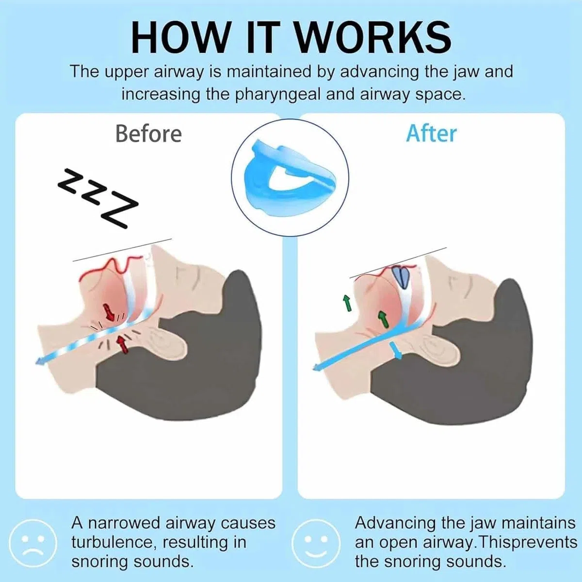 YUNFAN Anti Snoring Mouthpiece - Universal Size,Anti Snoring Devices for Sleep,Food Grade Material Snore Mouth Guard,Instantly Quiet Antisnoring Device Mouthpiece,Make The Night Quiet(2)